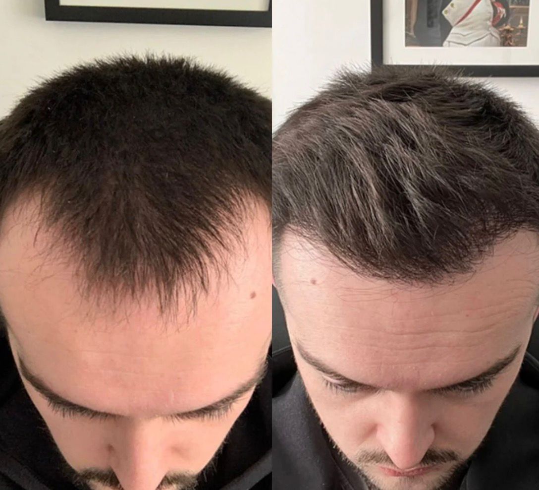 Rensola - Hair Growth Serum